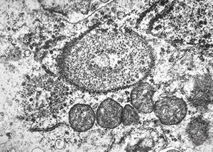 M,41y. | hairy cell leukemia - spleen - ribosome-lamella complex in tricholeukocyte M,41y. | hairy cell leukemia - spleen - ribosome-lamella complex in tricholeukocyte